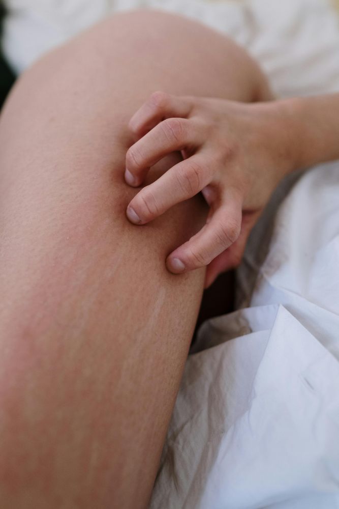 Krätze nach dem Urlaub: Was du wissen solltest