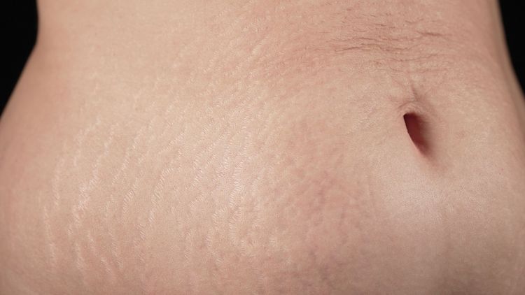 Bauch nach der Geburt – wann wird er wieder normal?
