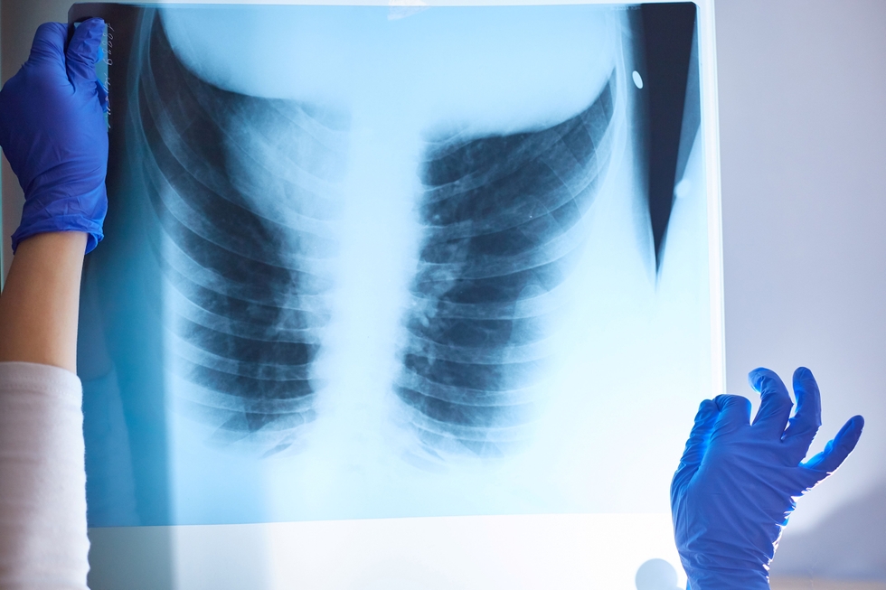 X-ray_Of_Lungs_original_578286.jpg