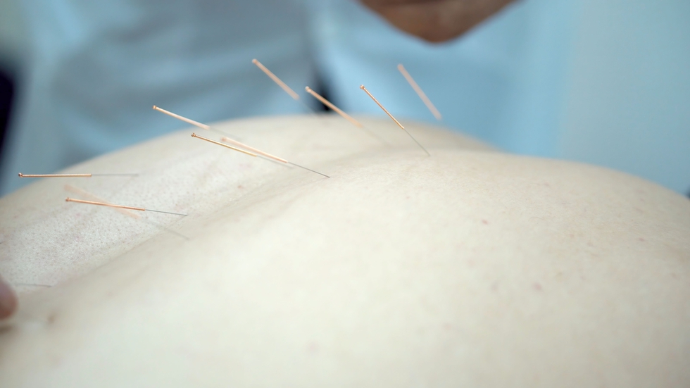 Close-up_On_Man_Getting_Acupuncture._Acupuncture_Needles_On_Back_original_2400239.jpg